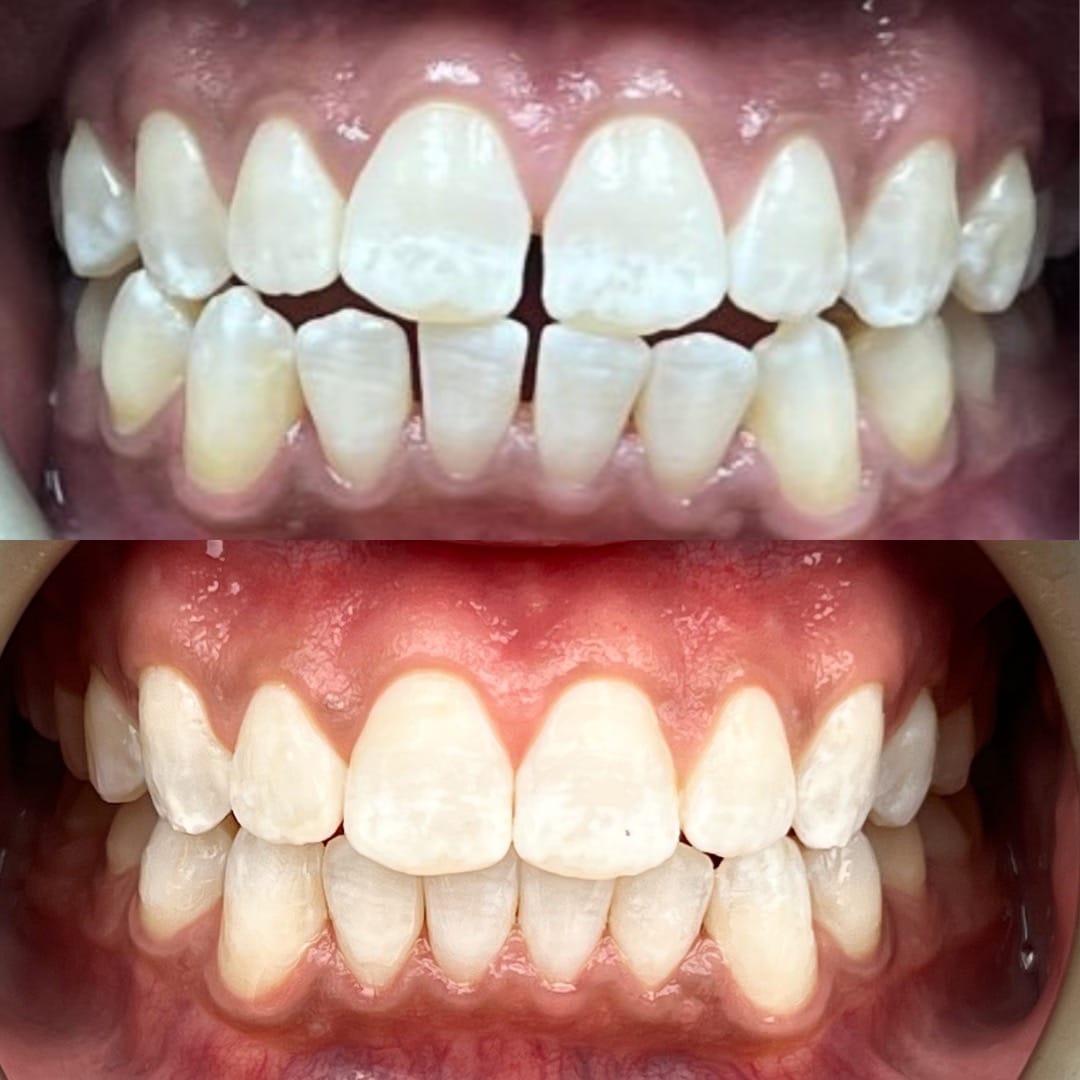 Smile Dental Vegas before and after photos 3