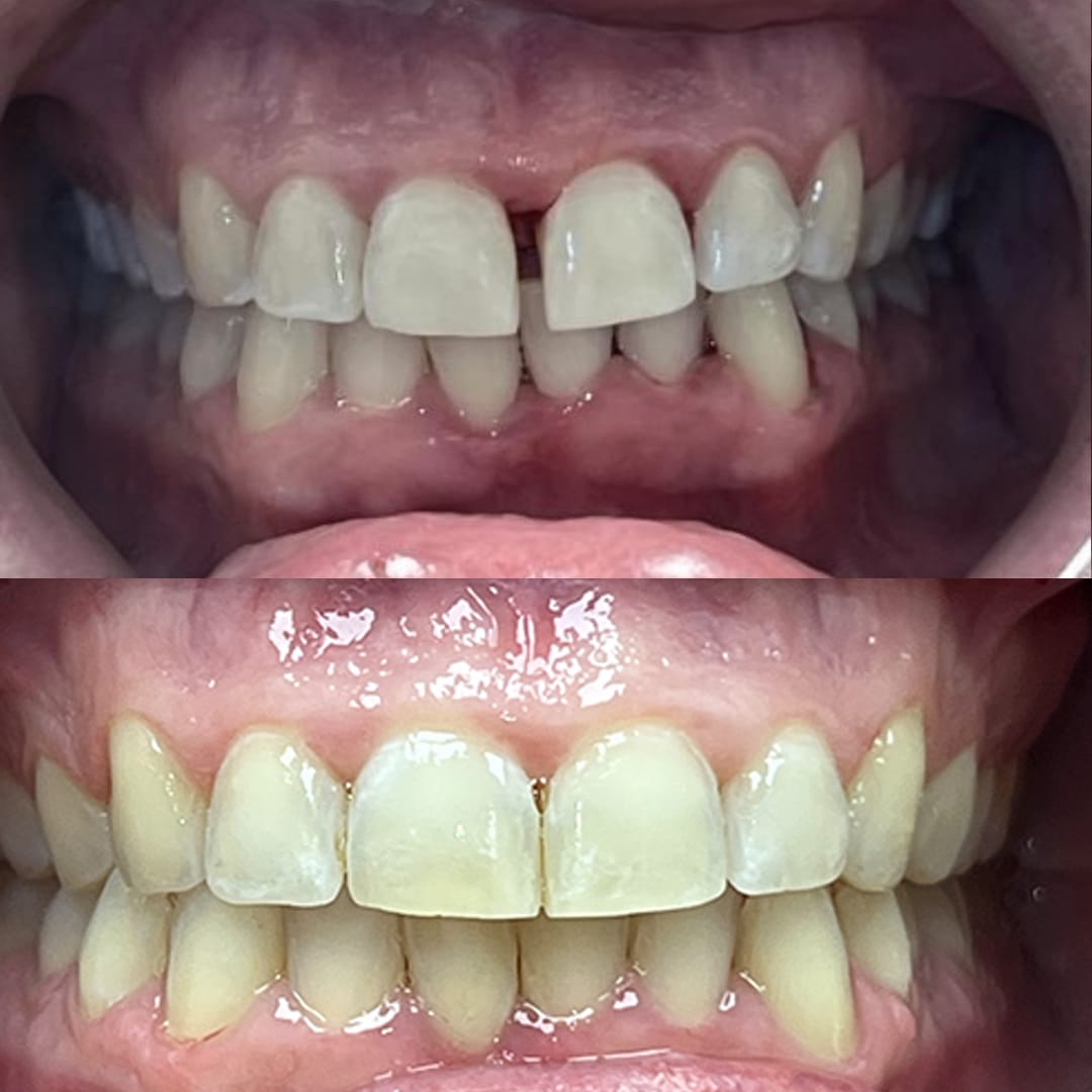 overbite and tooth gap