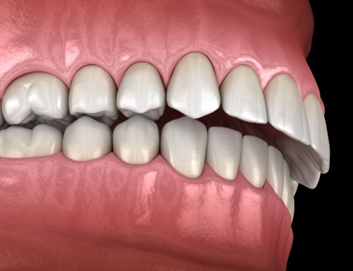 Underbites Unmasked: Understanding and Treating Your Smile