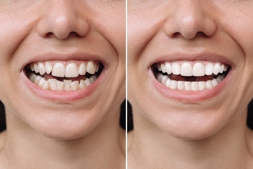 Veneers Unveiled: Enhancing Your Smile in Las Vegas