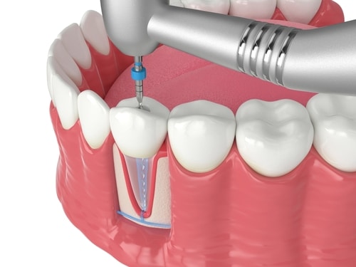 Root Canals: Guide to Dental Health