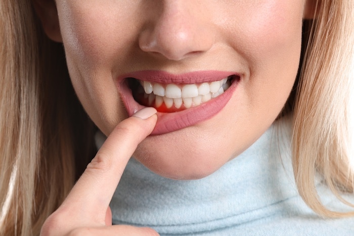 Gingivitis: Causes, Symptoms, and Effective Treatments