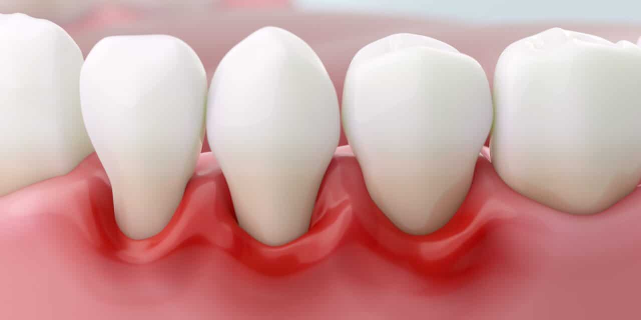 How to Get Rid of Gingivitis: A Treatment Guide