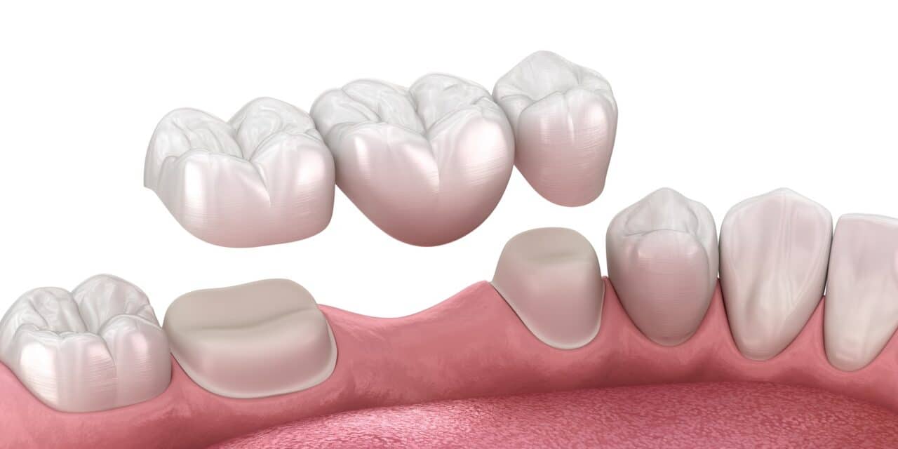 How Long Do Teeth Bridges Last? A Dental Guide