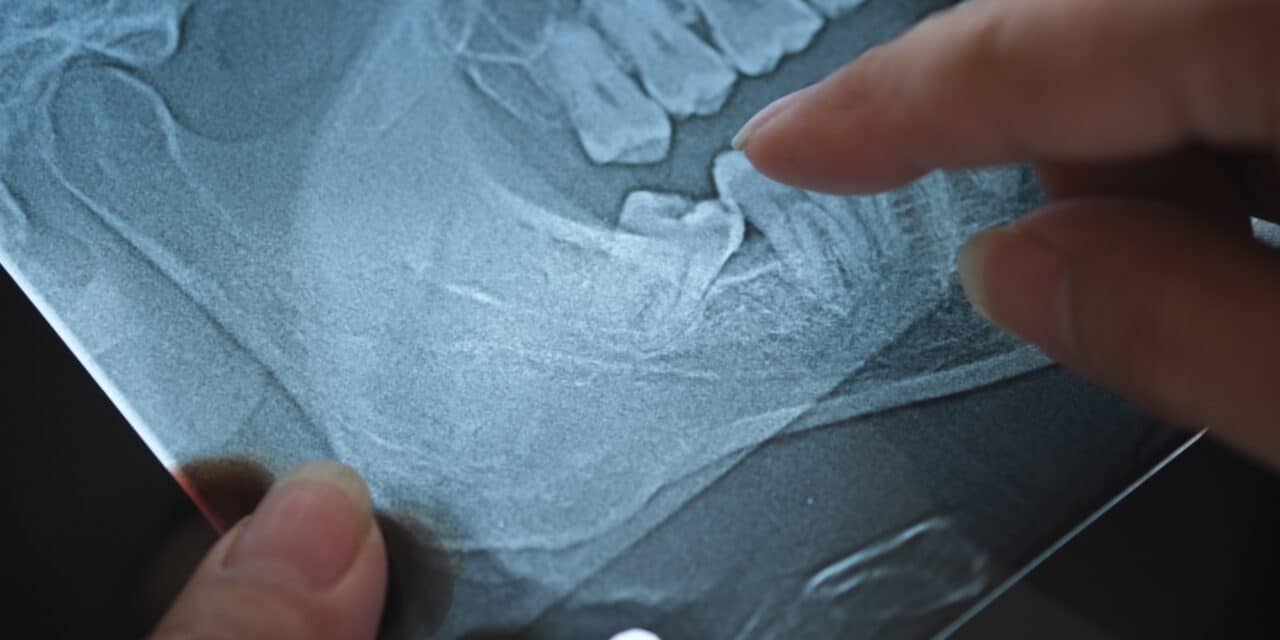 Wisdom Tooth Extraction Recovery: A Complete Healing Guide