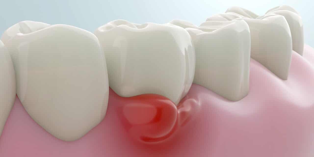 Can Gum Disease Kill You? Understanding the Risks