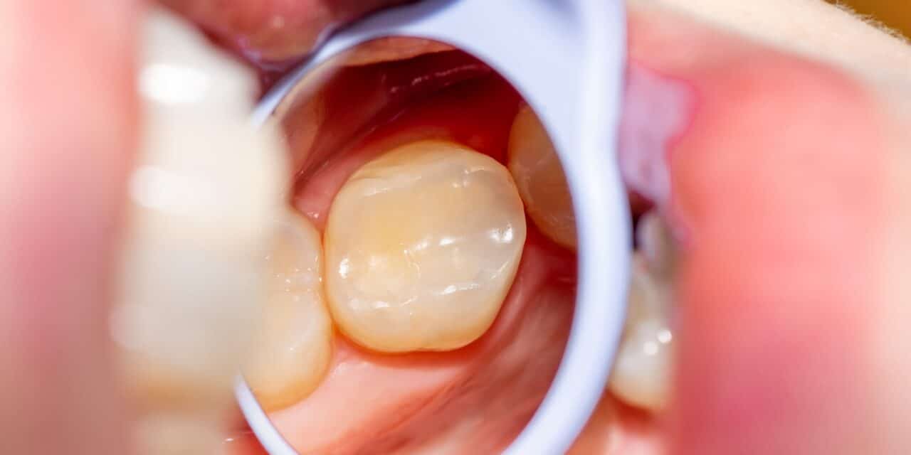 Dental Filling Recovery: How long does a filling take to heal?
