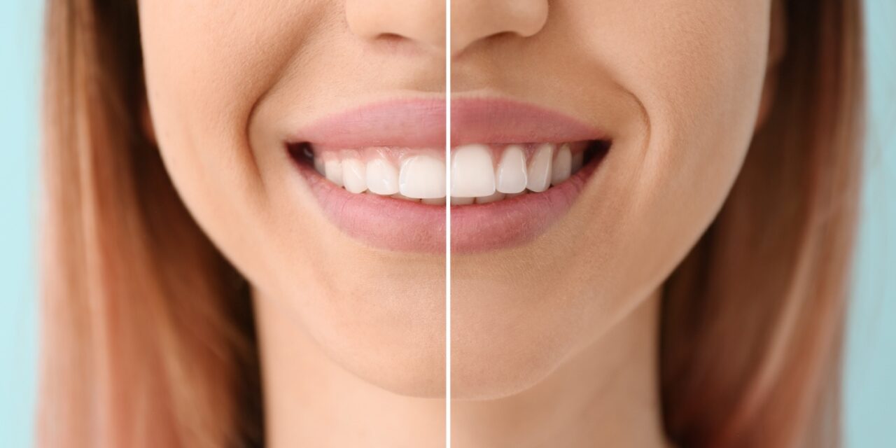Gum Contouring Healing: Your Recovery Roadmap
