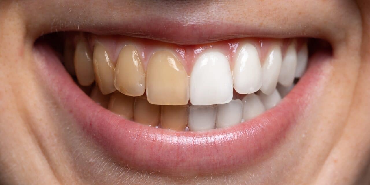 Black Stains on Teeth? 7 Proven Removal Methods Dentists Trust