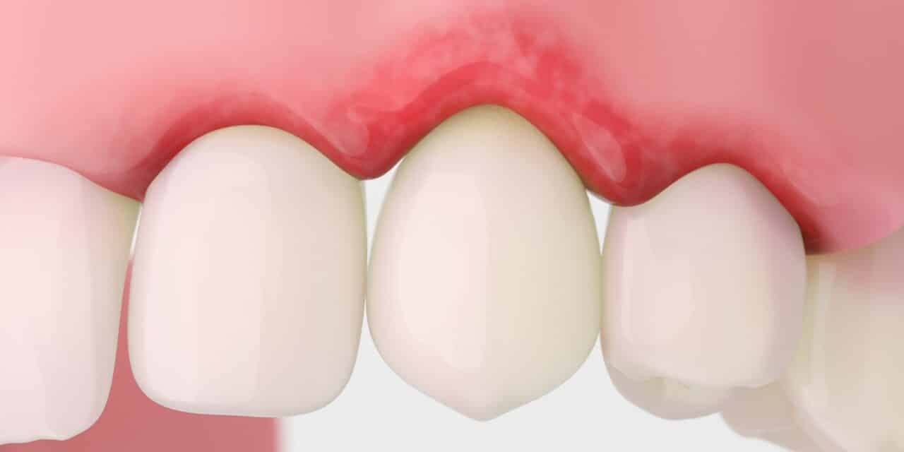 Can Receding Gums Be Reversed? The Truth About Gum Recovery