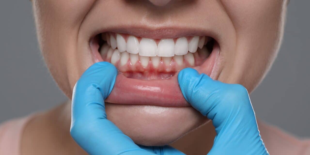 Receding Gums in Your 20s? Here’s Why It’s Happening Now