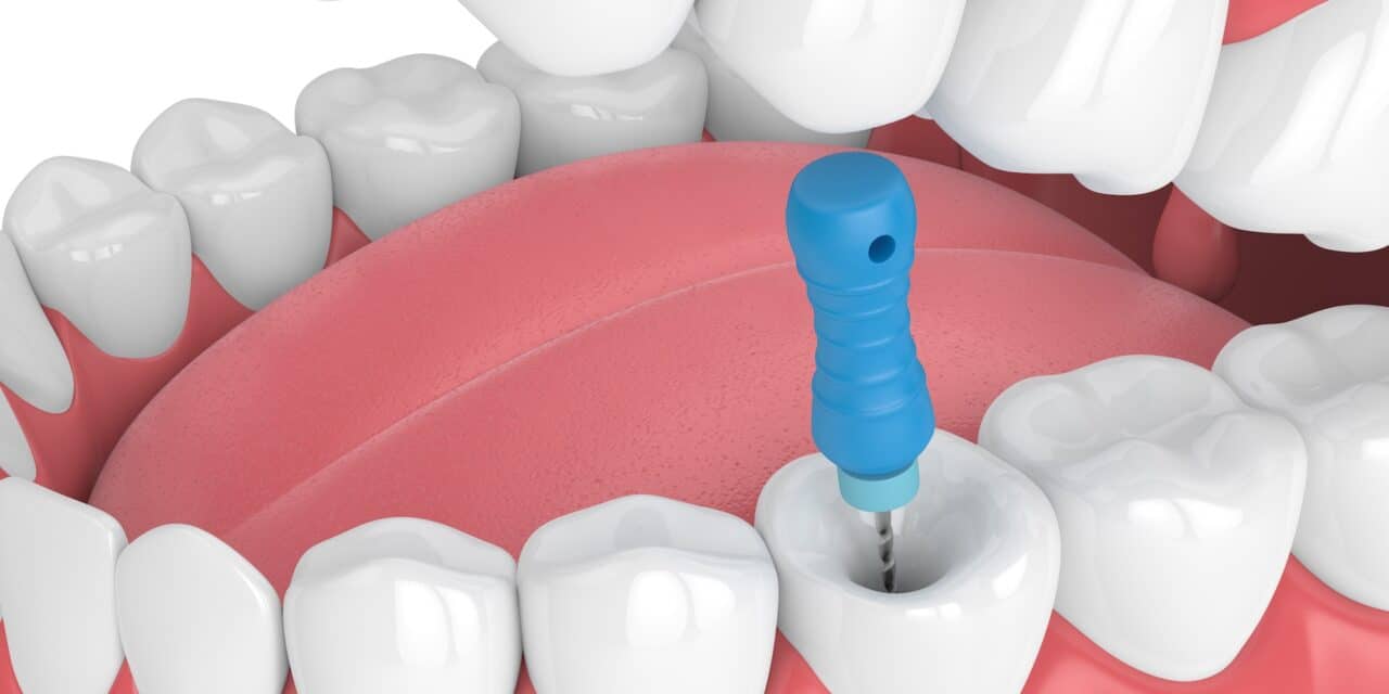 Reasons for Root Canal: 7 Warning Signs You Can’t Ignore