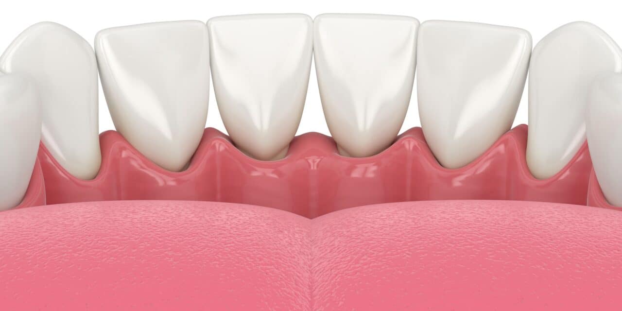 Gap Between Tooth and Gum: Causes and Fixes