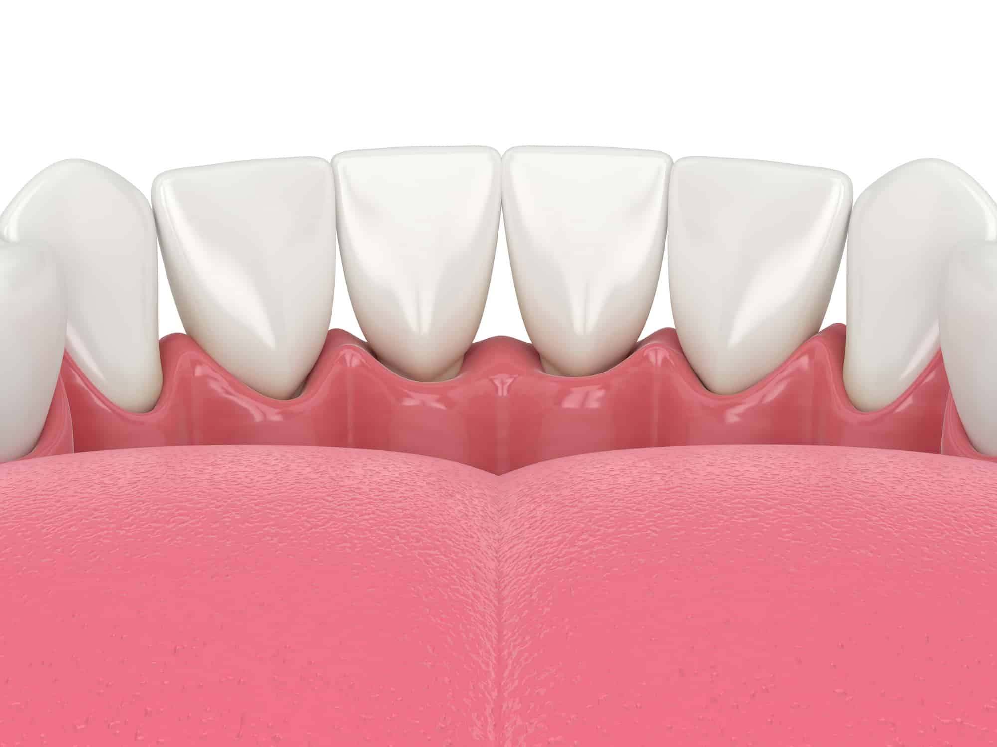 Gap Between Tooth and Gum: Causes and Fixes - Smile Vegas Dental