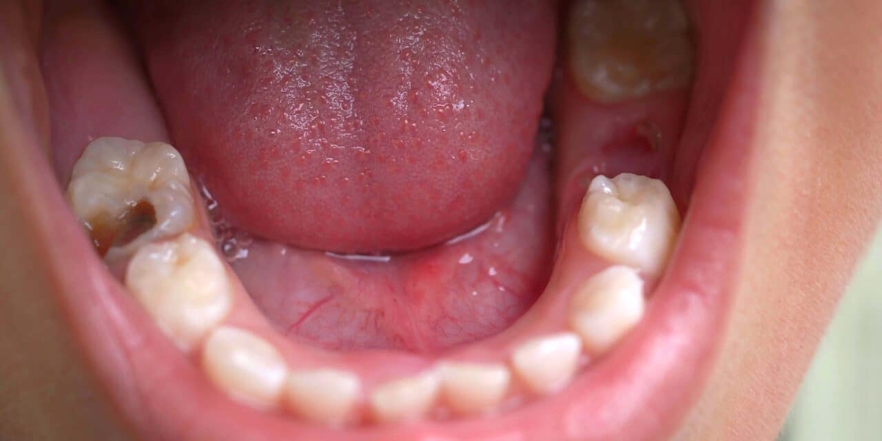 Reversing Bone Loss in Teeth Naturally That Actually Works